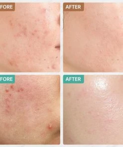 Top 10 ? Jinius - Pimple Patch Met Blackhead Remover - Acne Patch - Puisten Verwijderaar - Puisten Pleister - Acne Pleister - Acne Sticker - Puistjes Verwijderen - 108 Stuks + Comedonendrukker ✨ 6 Top 10 ? Jinius - Pimple Patch Met Blackhead Remover - Acne Patch - Puisten Verwijderaar - Puisten Pleister - Acne Pleister - Acne Sticker - Puistjes Verwijderen - 108 Stuks + Comedonendrukker ✨ -Tom Ford Shop 550x550 164