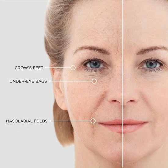 Hete verkoop ? BEAUTICAL Micronaadel Oog Patches - 80% Hyaluronzuur & Peptides - Microneedling Oogpatches, Oogmasker, Eye Patch, Eye Mask - Anti Rimpel, Anti Aging, Tegen Wallen - 1 Paar ? 5 Hete verkoop ? BEAUTICAL Micronaadel Oog Patches - 80% Hyaluronzuur & Peptides - Microneedling Oogpatches, Oogmasker, Eye Patch, Eye Mask - Anti Rimpel, Anti Aging, Tegen Wallen - 1 Paar ? - Afbeelding 5