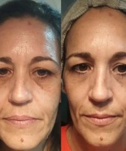 Hete verkoop ? BEAUTICAL Micronaadel Oog Patches - 80% Hyaluronzuur & Peptides - Microneedling Oogpatches, Oogmasker, Eye Patch, Eye Mask - Anti Rimpel, Anti Aging, Tegen Wallen - 1 Paar ? 16 Hete verkoop ? BEAUTICAL Micronaadel Oog Patches - 80% Hyaluronzuur & Peptides - Microneedling Oogpatches, Oogmasker, Eye Patch, Eye Mask - Anti Rimpel, Anti Aging, Tegen Wallen - 1 Paar ? -Tom Ford Shop 550x550 309