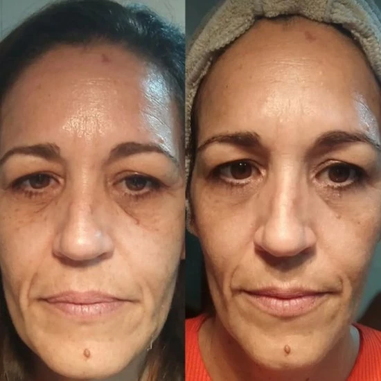 Hete verkoop ? BEAUTICAL Micronaadel Oog Patches - 80% Hyaluronzuur & Peptides - Microneedling Oogpatches, Oogmasker, Eye Patch, Eye Mask - Anti Rimpel, Anti Aging, Tegen Wallen - 1 Paar ? 6 Hete verkoop ? BEAUTICAL Micronaadel Oog Patches - 80% Hyaluronzuur & Peptides - Microneedling Oogpatches, Oogmasker, Eye Patch, Eye Mask - Anti Rimpel, Anti Aging, Tegen Wallen - 1 Paar ? - Afbeelding 6