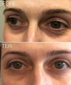 Hete verkoop ? BEAUTICAL Micronaadel Oog Patches - 80% Hyaluronzuur & Peptides - Microneedling Oogpatches, Oogmasker, Eye Patch, Eye Mask - Anti Rimpel, Anti Aging, Tegen Wallen - 1 Paar ? 20 Hete verkoop ? BEAUTICAL Micronaadel Oog Patches - 80% Hyaluronzuur & Peptides - Microneedling Oogpatches, Oogmasker, Eye Patch, Eye Mask - Anti Rimpel, Anti Aging, Tegen Wallen - 1 Paar ? -Tom Ford Shop 550x550 312